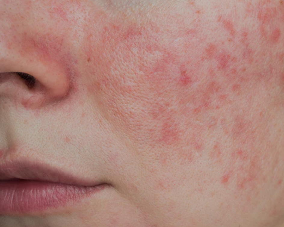 rosacea
